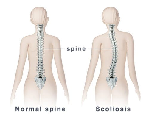 Duruş Bozukluklarında Yüzmenin Önemi